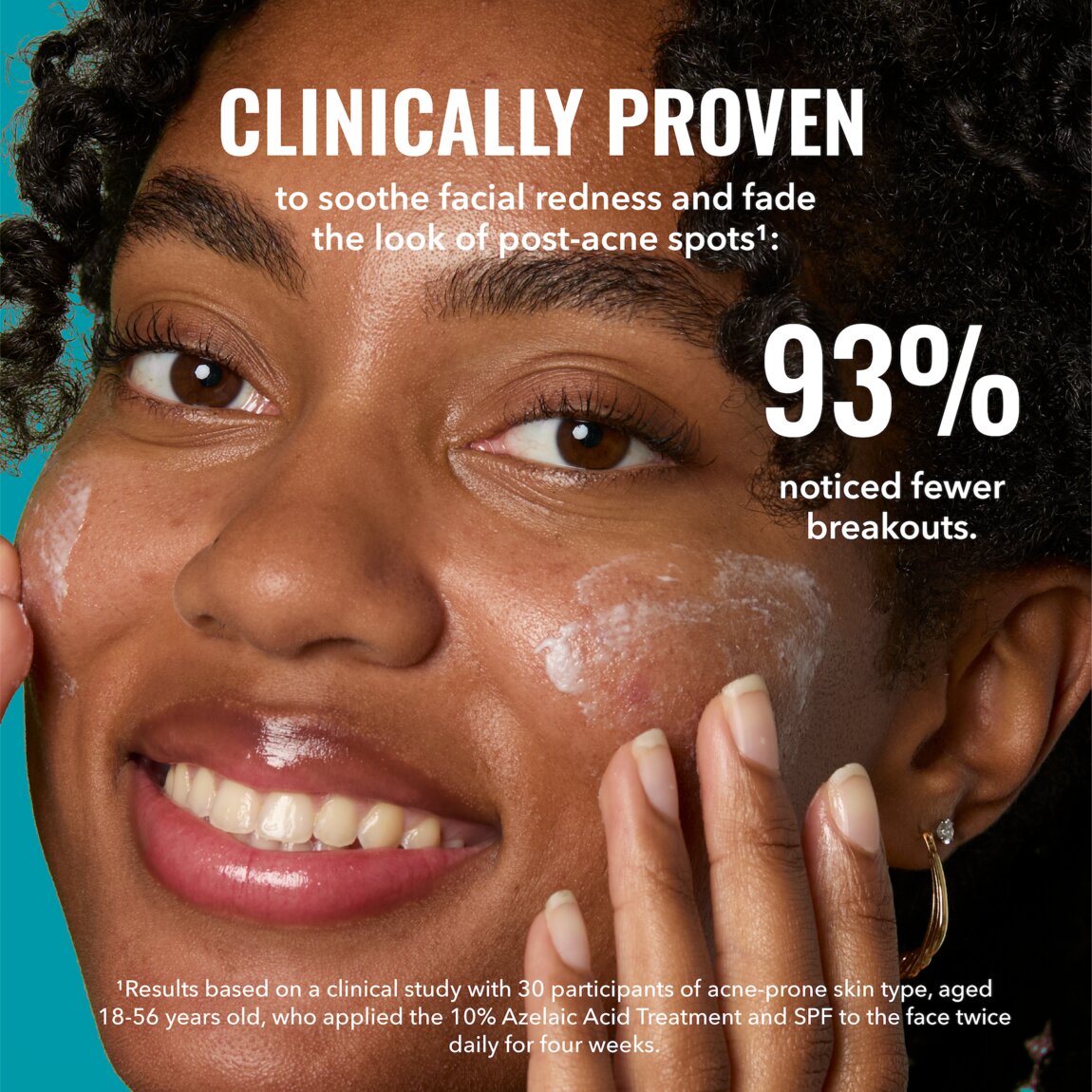 10-azelaic-acid-treatment-d3 zb_p.jpg