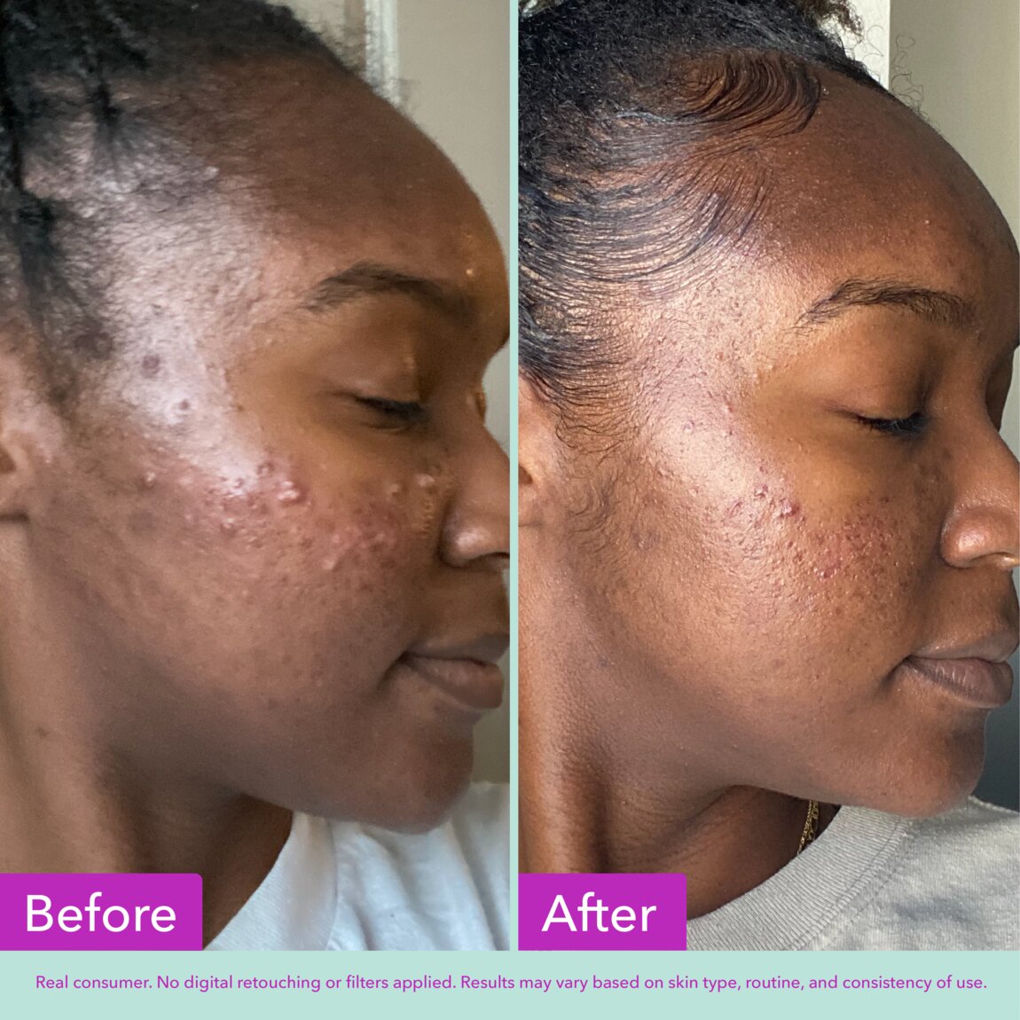 acne-foaming-cleanser-c7 zb_p.jpg